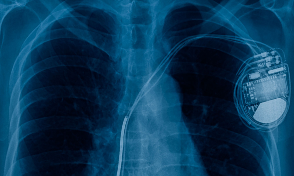 Biotronik Pays Nearly $13 Million for Alleged Kickbacks to Use its Cardiac Devices